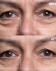 Eye Wrinkle Patches