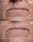Mouth & Lip Wrinkle Patches