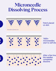 Self-Dissolving Microneedle Patches